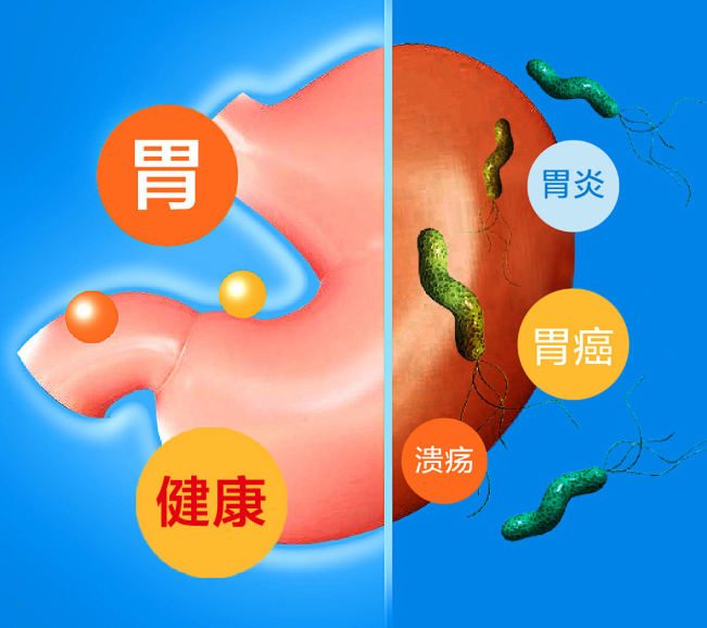 从胃炎到胃癌，幽门螺旋杆菌是如何一步步伤胃的？