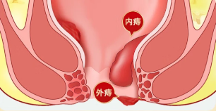 为什么肛肠疾病越来越&ldquo;喜欢&rdquo;年轻人？